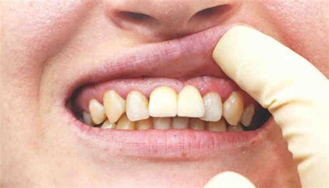 Can dental implant cause sinus infection - Dental News Network