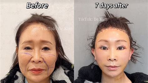 Dr. Kim Plastic Surgery TikTok, Explained