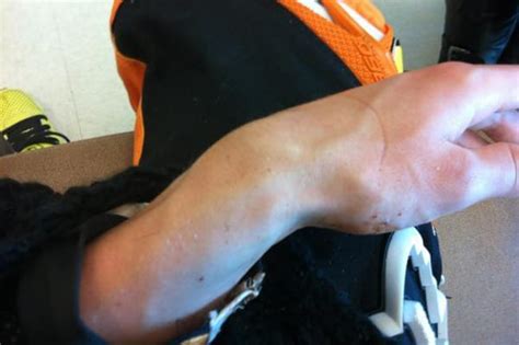 Roczen breaks arm | Dirtbike Rider