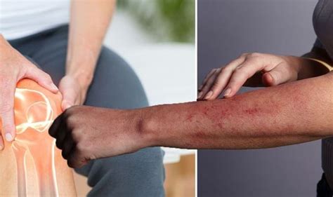 Rheumatoid arthritis symptoms: Lesions or rashes on skin is a sign | Express.co.uk