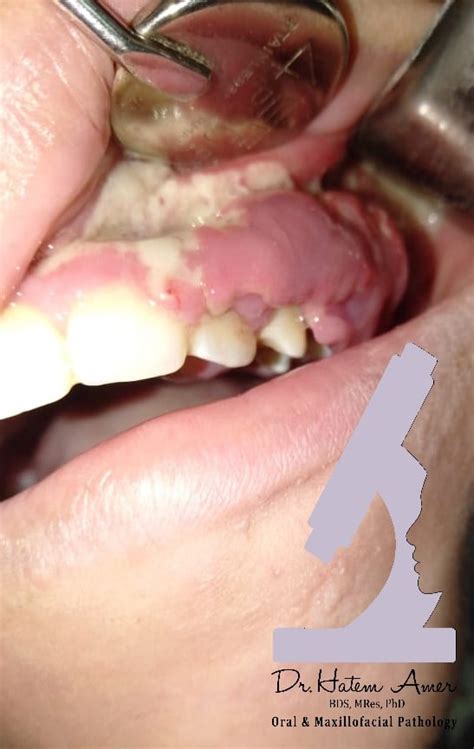 A case of Plasma cell gingivitis occurring in an 11 year old female patient that had underwent a ...