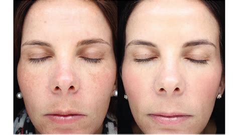 Halo Laser Resurfacing Before & After Photos | Face Forward Medical Aesthetics