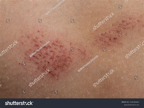 Scratches On Skin Background Stock Photo 2169360601 | Shutterstock