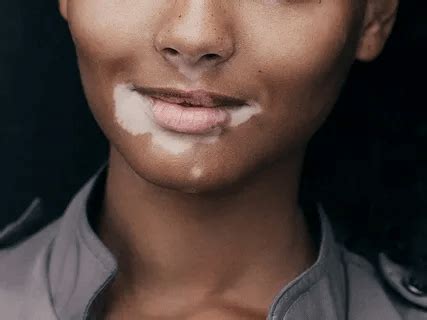 Segmental Vitiligo