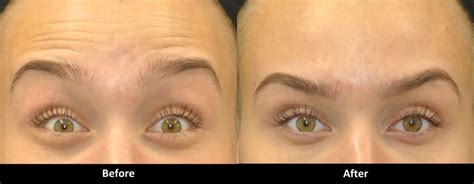 Fix heavy eyebrows after Botox