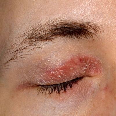 Eyelid Dermatitis (Eczema): Symptoms, Causes, And Treatment | atelier ...