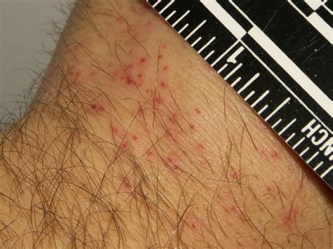 Pictures of Bed Bugs Bites on Real People | Debedbug