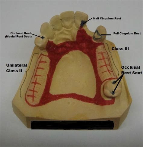 rest seats for partial denture - schickedanz-quentin