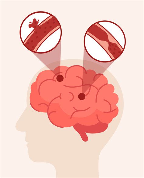 Stroke Overview: Causes and types, signs .. - SynappseHealth