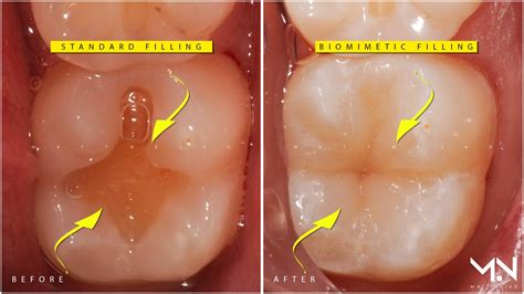 Replace Silver Fillings with Natural Biomimetic Restorations