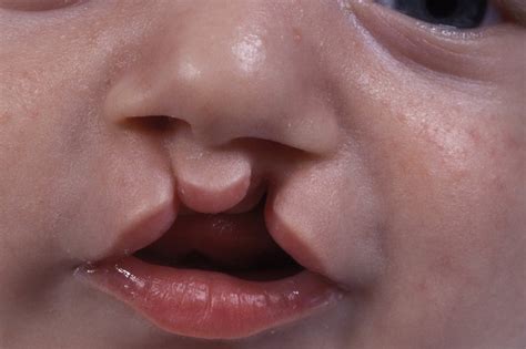 Cleft lip and palate - NHS