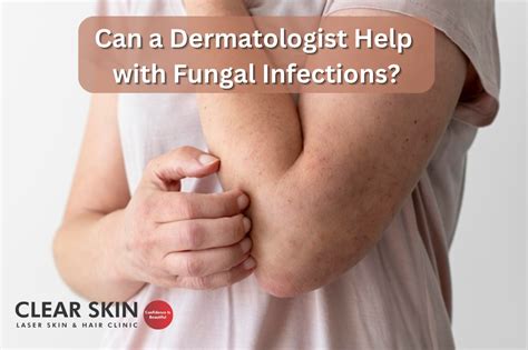 Can a Dermatologist Help with Fungal Infections?