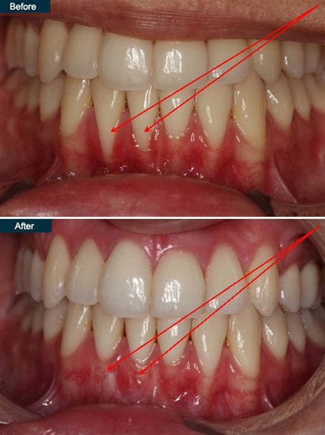 Gingivitis Before And After Treatment