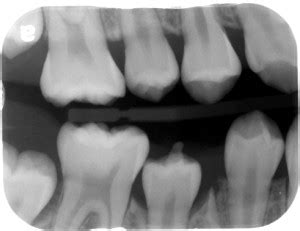 Case of the Week: Dens Evaginatus – Dr. G's Toothpix