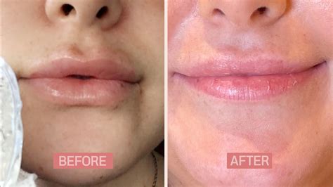 This Is What It’s Really Like to Dissolve Your Filler | Allure