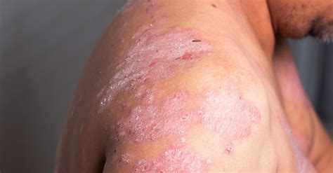 These Medications That Flare Up Plaque Psoriasis Should Be Stopped Now ...