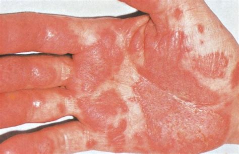 Image: Keratoderma Blennorrhagicum (Palm) - MSD Manual Professional Edition