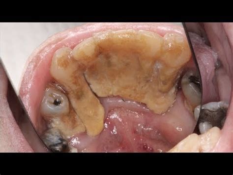 CLEANING OF THICK TARTAR | MASSIVE CALCULUS BUILDUP | SEVERE GUM ...