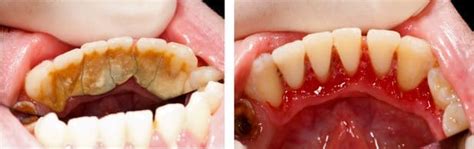 PARADONTOZA. PARADONTOPATIA. DIAGNOSTYKA. LECZENIE