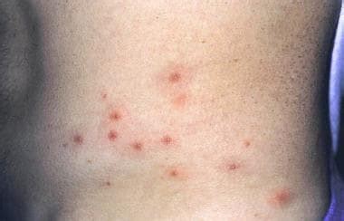 Pseudomonas Aeruginosa Skin Infection