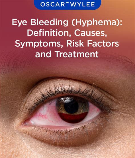 Eye Bleeding (Hyphema): Definition, Causes, Symptoms, Risk Factor and Treatment