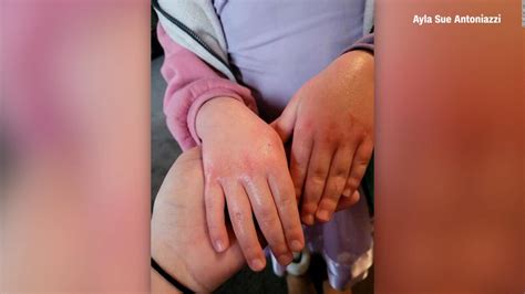 Ohioans Report Skin Rashes, Other Symptoms After Toxic Train Crash - The Limited Times