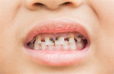 Rotten Teeth In Children Stock Photos, Pictures & Royalty-Free Images - iStock