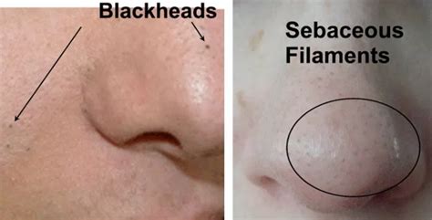 What Are Sebaceous Filaments? Treatment – It Fashion