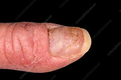 Dystrophic nail in chronic eczema - Stock Image - C038/1554 - Science ...