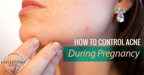 How To Control Acne During Pregnancy - Annex Naturopathic Clinic