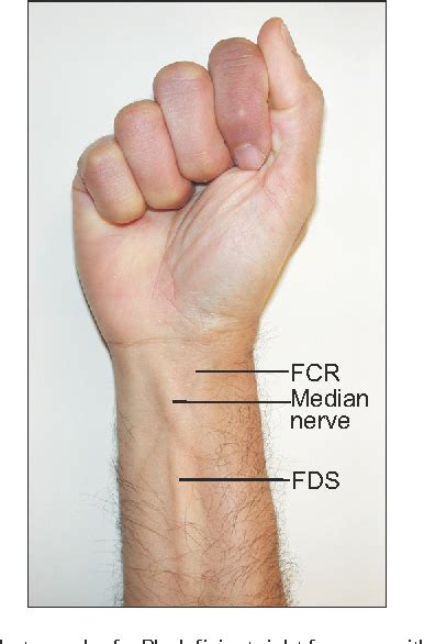 Table 1 from That Tendon is the Median Nerve: Perils of a Palmaris ...