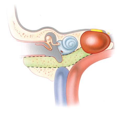 Approaches to the Petrous Apex – Skull Base Surgery Atlas