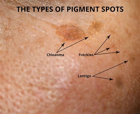 How To Treat Hyperpigmentation Spots | Justinboey