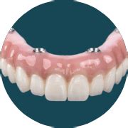 Hybrid Denture with Titanium Bar [Best Methods + Advantages] - STOMADENT
