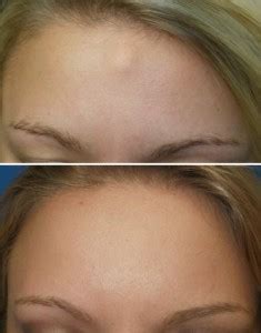 Forehead Osteomas and Their Treatment