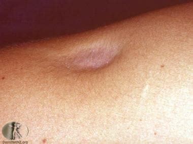 Dermatologic Manifestations of Localized Lipodystrophy: Background, Pathophysiology, Etiology