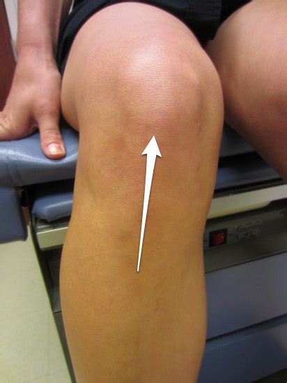 Patellar tendonitis: Signs, symptoms and remedies for this difficult ...