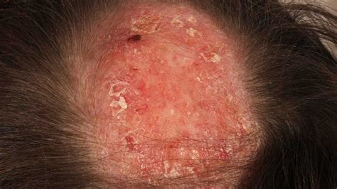 Lupus Scalp Lesions