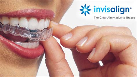 Invisalign - Solutia Ortodontica Moderna » Miodent Clinic