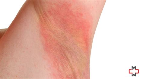 Armpit Rash: Causes, Treatment and Prevention