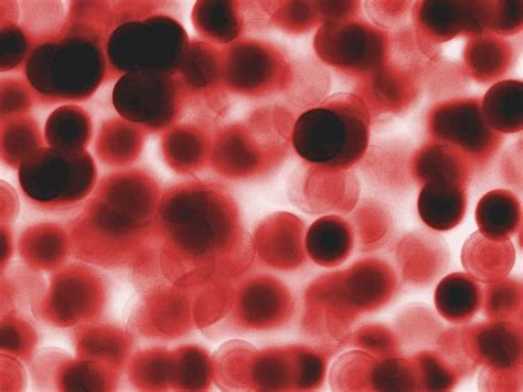 Macrocytic Anemia: Symptoms, Types, and Treatment