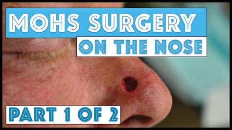 Mohs Surgery on the nose: Part 1 of 2, Taking Mohs Layers - YouTube