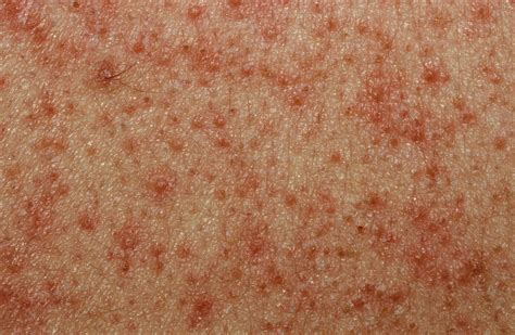 Infected keratosis pilaris – Ericvisser