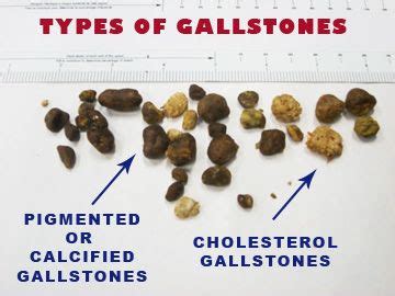 GALL BLADDER STONE : CAUSES AND TREATMENT |FINDYOURSELF - Findyourself343 | notes for medical topics