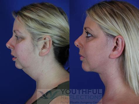 Chin Implant Before & After Photos Patient 64 | Nashville, TN ...