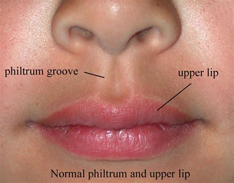 Philtrum of lip, causes of smooth philtrum, long or short philtrum