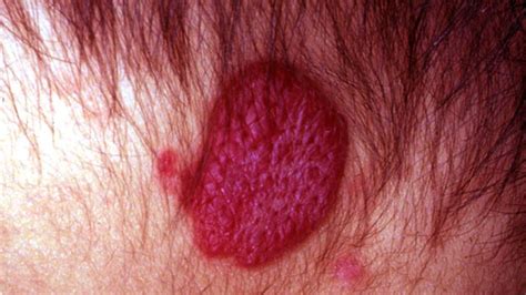 Raised Skin Bumps Pictures Causes And Treatment | Images and Photos finder