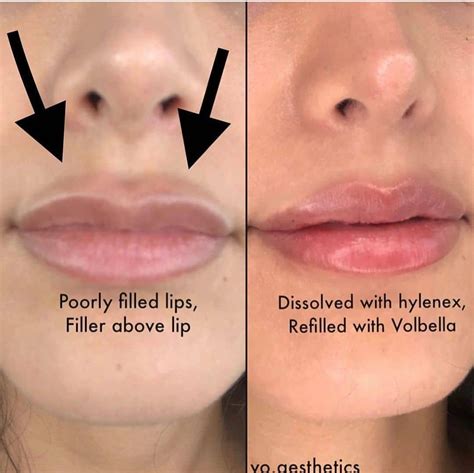 Pin by CyGht on chirurgie | Botox lips, Lips inspiration, Lip fillers