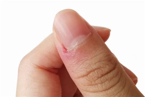 Finger Infection