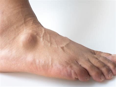 What Is A Ganglion On The Foot Store | emergencydentistry.com